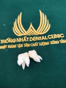 Nhổ Răng Khôn Uy Tín Số 1 Vĩnh Phúc